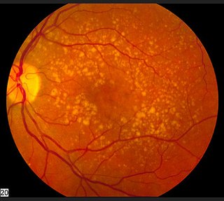 Macular Degeneration Symptoms - Blurred Vision, Wavy Lines, Faded Colors