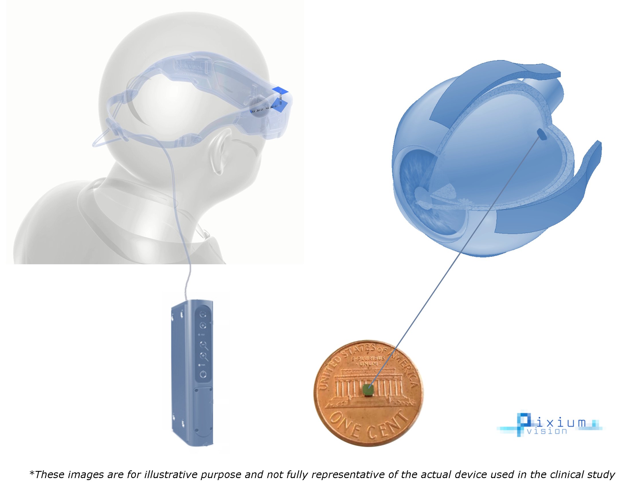 Macular Degeneration Treatment Breakthrough Improves Lost